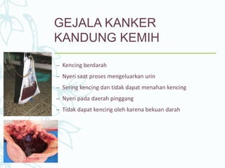 GEJALA KANKER
KANDUNG KEMIH
– Kencing berdarah
– Nyeri saat proses mengeluarkan urin
– Sering kencing dan tidak dapat menahan kencing
– Nyeri pada daerah pinggang
– Tidak dapat kencing oleh karena bekuan darah
 