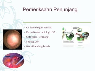 Pemeriksaan Penunjang
– CT Scan dengan kontras
– Pemeriksaan radiologi USG
– Sistoskopi (Teropong)
– Sitologi urin
– Biopsi kandung kemih
 