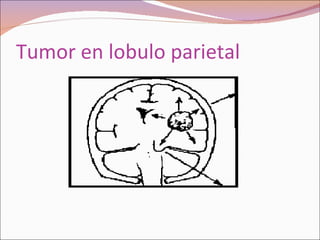 Tumor en lobulo parietal 