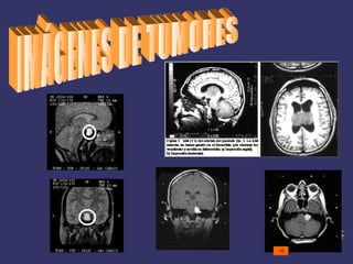 IMÁGENES DE TUMORES Atrás 
