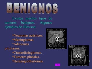 Existen muchos tipos de tumores benignos. Algunos ejemplos de ellos son: Neuromas acústicos. Meningiomas. Adenomas    pituitarios. Craneofaringiomas. Tumores pineales. Hemangioblastomas. BENIGNOS 