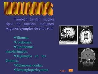 También existen muchos tipos de tumores malignos. Algunos ejemplos de ellos son: Gliomas. Cordomas. Carcinomas  nasofaríngeos. Originados en los  Glomus. Melanoma ocular. Hemangiopericytoma. MALIGNOS Atrás 