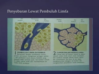 Penyebaran Lewat Pembuluh Limfa
 