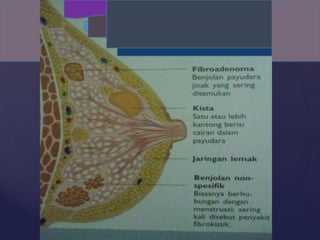 Gambar : Benjolan Payudara hal 226 ( atas )
 