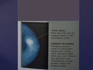 Gambar : Kanker Payudara hal 226
 