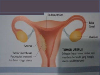    Gambar kanker uterus
   Hal 227
 