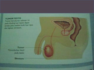    Kanker testis hal 228
 