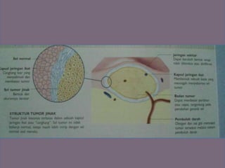 Gambar struktur tumor ganas hal 236 bagian atas
 