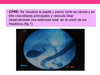 • CPRE: Se visualiza la papila y previo corte se cánula y se

tiñe vías biliares principales y vesícula biliar
observándose una estenosis total en la unión de los
hepáticos.(fig.1)

 