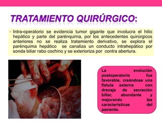 • Intra-operatorio se evidencia tumor gigante que involucra el hilio

hepático y parte del parénquima, por los antecedentes quirúrgicos
anteriores no se realiza tratamiento derivativo, se explora el
parénquima hepático se canaliza un conducto intrahepático por
sonda biliar rabo cochino y se exterioriza por contra abertura.

La
evolución
postoperatoria
fue
favorable, creándose una
fístula externa
con
drenaje
de
secreción
biliar,
abundante
y
mejorando
las
características
del
paciente.

 