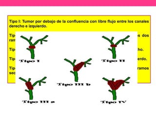 Tipo I: Tumor por debajo de la confluencia con libre flujo entre los canales
derecho e izquierdo.

Tipo II: Tumor que obstruye la confluencia con compromiso de los dos
ramos principales
Tipo IIIa: Tumor que obstruye la confluencia y el ramo principal derecho.
Tipo IIIb: Tumor que obstruye la confluencia y el ramo principal izquierdo.
Tipo IV: Tumor que compromete ambos ramos principales y ramos
secundarios.

 