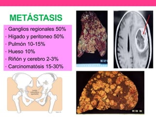 METÁSTASIS
• Ganglios regionales 50%
• Hígado y peritoneo 50%
• Pulmón 10-15%
• Hueso 10%
• Riñón y cerebro 2-3%

• Carcinomatósis 15-30%

 