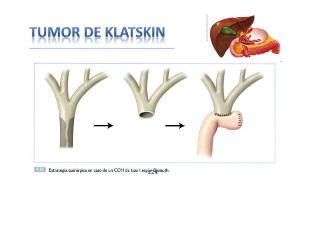 Tumor de klatskin