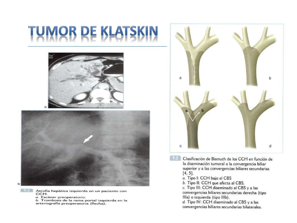 Artículos Que Es Tumor De Klatskin