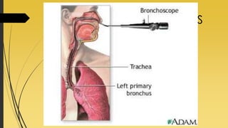 TÉCNICAS DIAGNÓSTICAS
Citologia de Escarro:
 Coleta de material em dias consecutivos;
É mais sensível para tumores centrais.
Broncofibroscopia:
Técnica definitiva para o diagnóstico;
Visualização da lesão: traqueia, brônquios;
Acurácia do exame é alta para os tumores
centrais;
 
