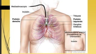 TÉCNICAS DIAGNÓSTICAS
 Biópsia por agulha transcutânea:
A fluroscopia e a tomografia computadorizada de
tórax são os principais auxiliares para este
procedimento;
Grande acurácia;
 Mediastinoscopio:
Método utilizado para melhorar o estadiamento ao
mediastino, em casos de lesão ganglionar em
mediastino;
 Biópsia a Céu Aberto:
Indicada quando os métodos anteriores (menos
invasivos) falharam em dar o diagnóstico;
 