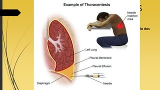 TÉCNICAS DIAGNÓSTICAS
 Toracocentese:
 é a técnica cirúrgica responsável pela obtenção da maioria das
amostras de líquido pleural (derrame pleural) que são
encaminhadas para diagnóstico laboratorial;
 Indicado em casos de derrame pleural.
 