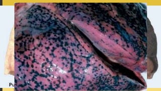 ETIOLOGIA E PATOGENIA
 