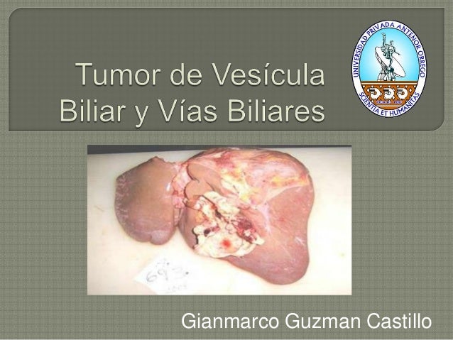 Tumor de vesícula biliar y vías biliares