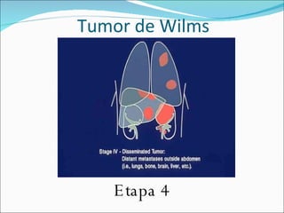 Tumor de Wilms | PPT