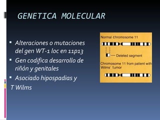 GENETICA MOLECULAR

 Alteraciones o mutaciones
  del gen WT-1 loc en 11p13
 Gen codifica desarrollo de
  riñón y genitales
 Asociado hipospadias y
T Wilms
 