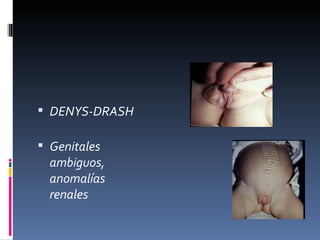  DENYS-DRASH

 Genitales
  ambiguos,
  anomalías
  renales
 