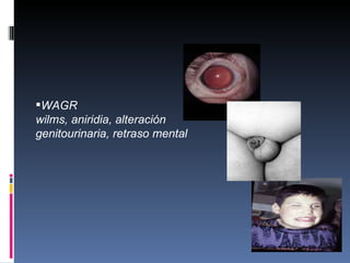 WAGR
wilms, aniridia, alteración
genitourinaria, retraso mental
 
