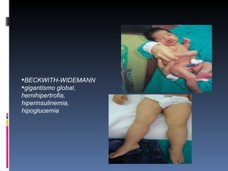 BECKWITH-WIDEMANN
gigantismo global,
hemihipertrofia,
hiperinsulinemia,
hipoglucemia
 