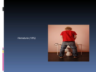Hematuria (18%)
 