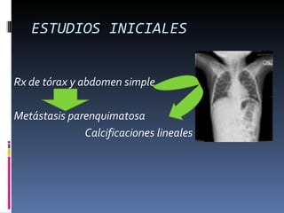 ESTUDIOS INICIALES


Rx de tórax y abdomen simple

Metástasis parenquimatosa
              Calcificaciones lineales
 