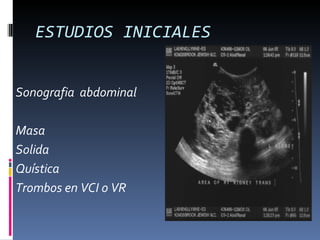 ESTUDIOS INICIALES


Sonografia abdominal

Masa
Solida
Quística
Trombos en VCI o VR
 