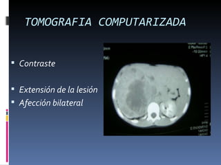 TOMOGRAFIA COMPUTARIZADA


 Contraste


 Extensión de la lesión
 Afección bilateral
 