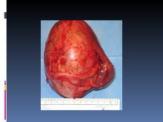 Tumor de wilms