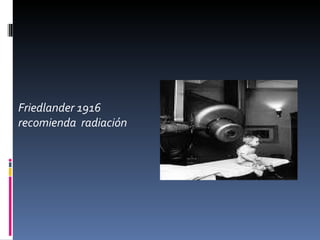 Friedlander 1916
recomienda radiación
 
