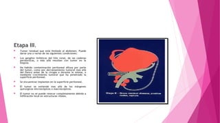 Etapa III.
 Tumor residual que está limitado al abdomen. Puede
darse una o varias de las siguientes condiciones:
 Los ganglios linfáticos del hilo renal, de las cadenas
periaorticas, o más allá resultan con tumor en la
biopsia.
 Ha habido contaminación peritoneal difusa por parte
del tumor, como por derramamiento tumoral mas allá
del flanco antes de la cirugía o durante la misma, o
mediante crecimiento tumoral que ha penetrado la
superficie peritoneal.
 Se encuentran implantes en la superficie peritoneal.
 El tumor se extiende mas allá de los márgenes
quirúrgicos microscópicos o macroscópicos.
 El tumor no se puede resecar completamente debido a
infiltración local en estructuras vitales.
 