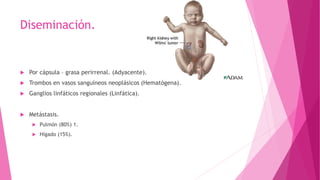 Diseminación.
 Por cápsula – grasa perirrenal. (Adyacente).
 Trombos en vasos sanguíneos neoplásicos (Hematógena).
 Ganglios linfáticos regionales (Linfática).
 Metástasis.
 Pulmón (80%) 1.
 Hígado (15%).
 