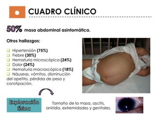 CUADRO CLÍNICO
masa abdominal asintomática.
Otros hallazgos:
 Hipertensión (75%)
 Fiebre (30%)
 Hematuria microscópica (24%)
 Dolor (24%)
 Hematuria macroscópica (18%)
 Náuseas, vómitos, disminución
del apetito, pérdida de peso y
constipación.
Tamaño de la masa, ascitis,
aniridia, extremidades y genitales.
 