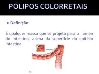 SEQUÊNCIA ADENO-CARCINOMAA sequência adenoma-carcinoma agora é reconhecida como o processo pelo qual a maioria dos carcinomas colorretais se desenvolvem: através de uma progressão de pólipos benignos até o carcinoma invasivo.Nome