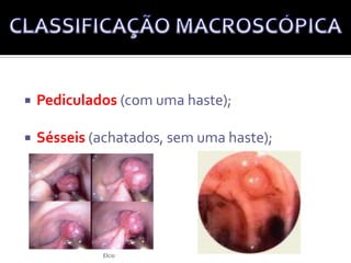 Definição: É qualquer massa que se projeta para o  lúmen do intestino, acima da superfície do epitélio intestinal.PÓLIPOS COLORRETAISElcio