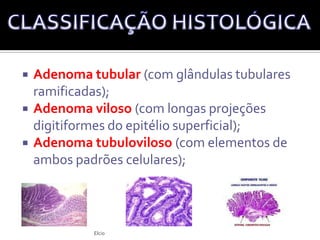 Pediculados (com uma haste);Sésseis (achatados, sem uma haste); CLASSIFICAÇÃO MACROSCÓPICAElcio