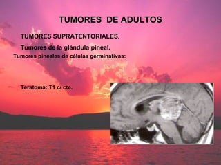 TUMORES SUPRATENTORIALES . Tumores de la glándula pineal. TUMORES  DE ADULTOS Tumores pineales de células germinativas: Te...