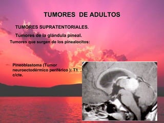 TUMORES SUPRATENTORIALES . Tumores de la glándula pineal. TUMORES  DE ADULTOS Tumores que surgen de los pinealocitos: Pine...