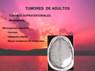 TUMORES SUPRATENTORIALES . Meningioma. TUMORES  DE ADULTOS <ul><li>Meningiomas infantiles: </li></ul><ul><ul><li>Varones. ...