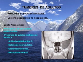 TUMORES  DE ADULTOS TUMORES SUPRATENTORIALES . Lesiones ocupantes no neoplasicas. <ul><li>Quiste Aracnoideos: </li></ul><u...