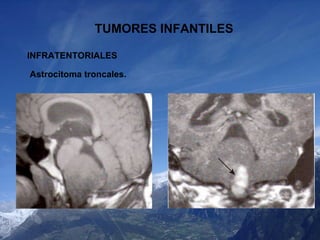 TUMORES INFANTILES INFRATENTORIALES Astrocitoma troncales. 