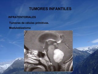 TUMORES INFANTILES INFRATENTORIALES Tumores de células primitivas. Meduloblastoma 