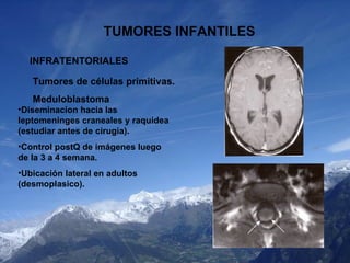 TUMORES INFANTILES INFRATENTORIALES Tumores de células primitivas. Meduloblastoma <ul><li>Diseminacion hacia las leptomeni...