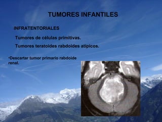 TUMORES INFANTILES INFRATENTORIALES Tumores de células primitivas. Tumores teratoides rabdoides atípicos. <ul><li>Descarta...