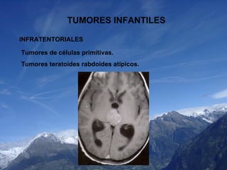TUMORES INFANTILES INFRATENTORIALES Tumores de células primitivas. Tumores teratoides rabdoides atípicos. 