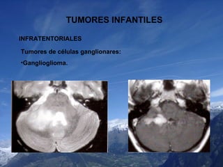 TUMORES INFANTILES INFRATENTORIALES <ul><li>Tumores de células ganglionares: </li></ul><ul><li>Ganglioglioma. </li></ul>